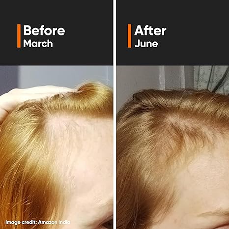 MINIMALIST HAIR GROWTH ACTIVES 18% - 30ML