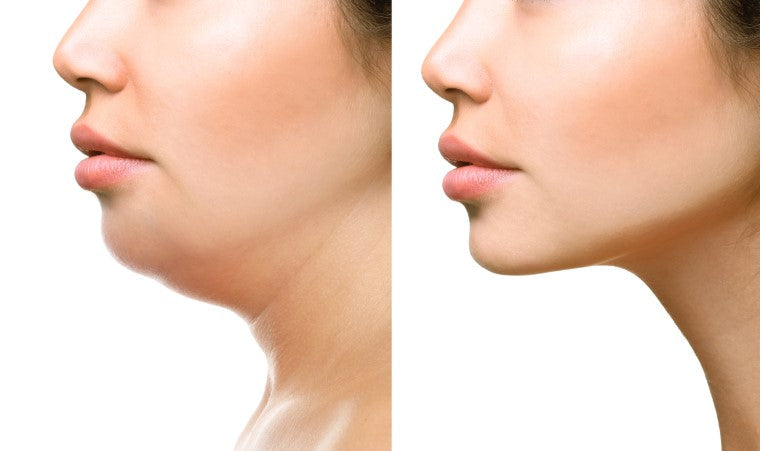 Remove Double Chin - Small Fat Face